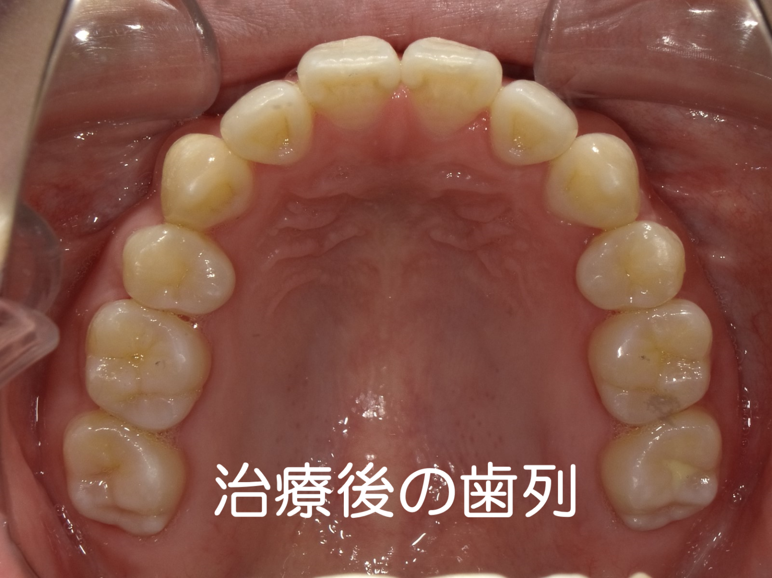 インプラント治療のリッジマネジメントを究める～抜歯における診断と